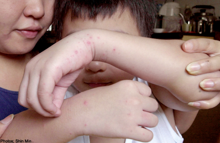 Number of HFMD cases race up