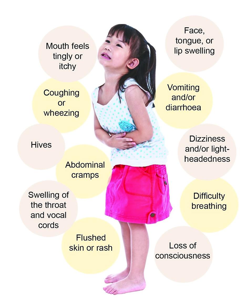 symptoms of food allergy ile ilgili görsel sonucu