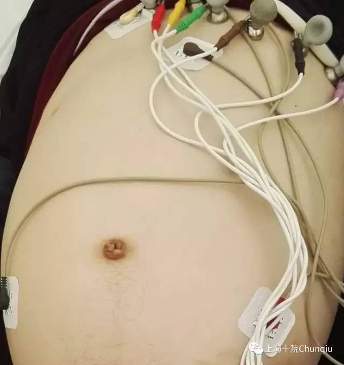 Constipé depuis sa naissance, un homme se fait retirer 13 kg de matières fécales de ses intestins (Photos)