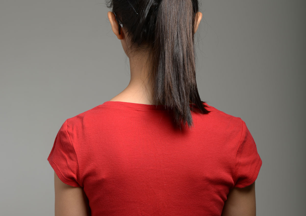 Anorexia Hair Loss Pictures