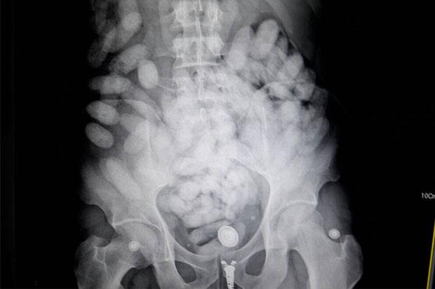 Brazilian man arrested for carrying 1.3kg of cocaine in stomach at