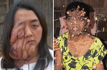 Women disfigured by horrific tumours given new faces, Health News - AsiaOne