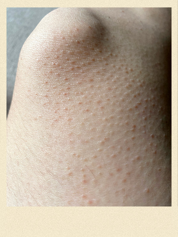 Red Bumps On Skin Keratosis Pilaris How To Get Rid Of