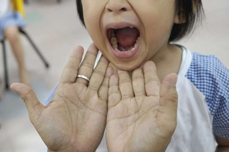 What is HFMD?, Health News AsiaOne