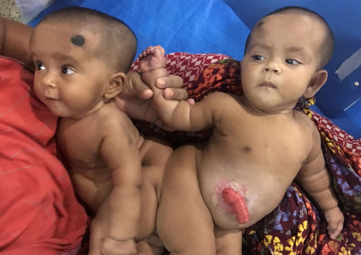 Bangladesh performs 'first' conjoined twin surgery.