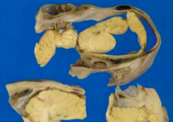 Surgeons Discover Tiny Brain Skull And Hair In Japanese Teen S Ovary Health Asia News Asiaone