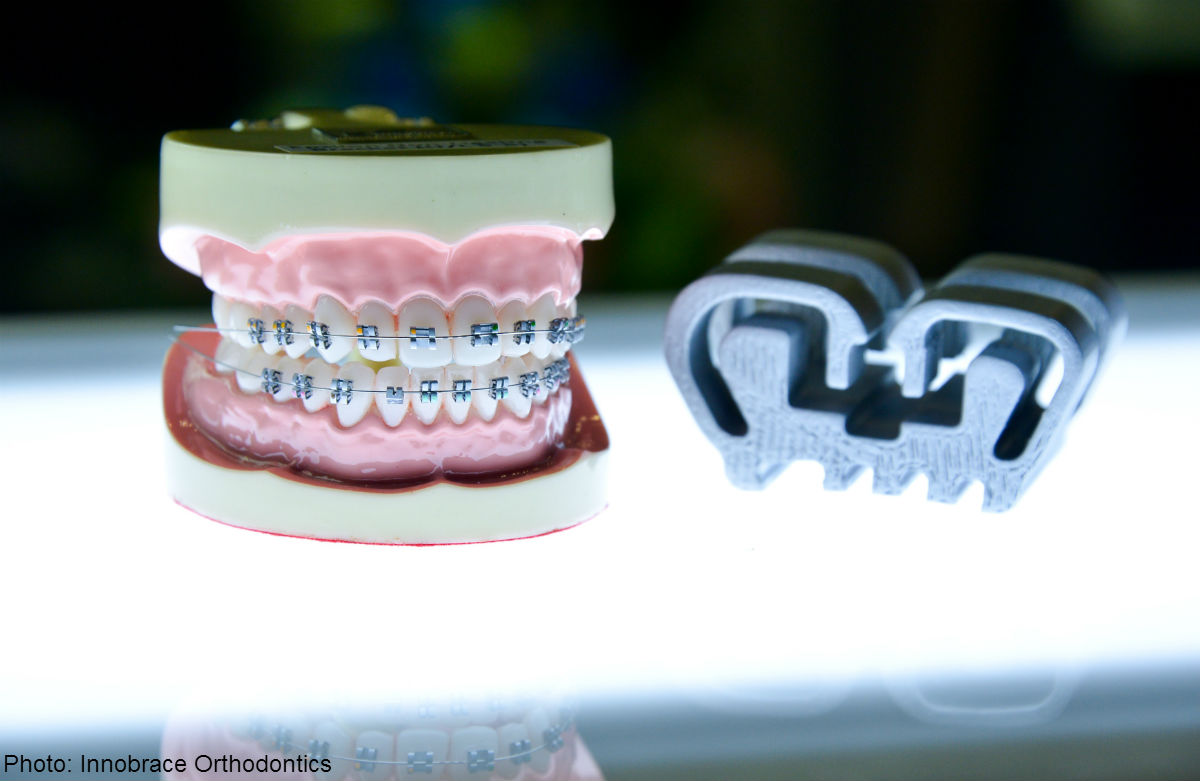 Cut treatment time, dentist visits with these braces, News AsiaOne