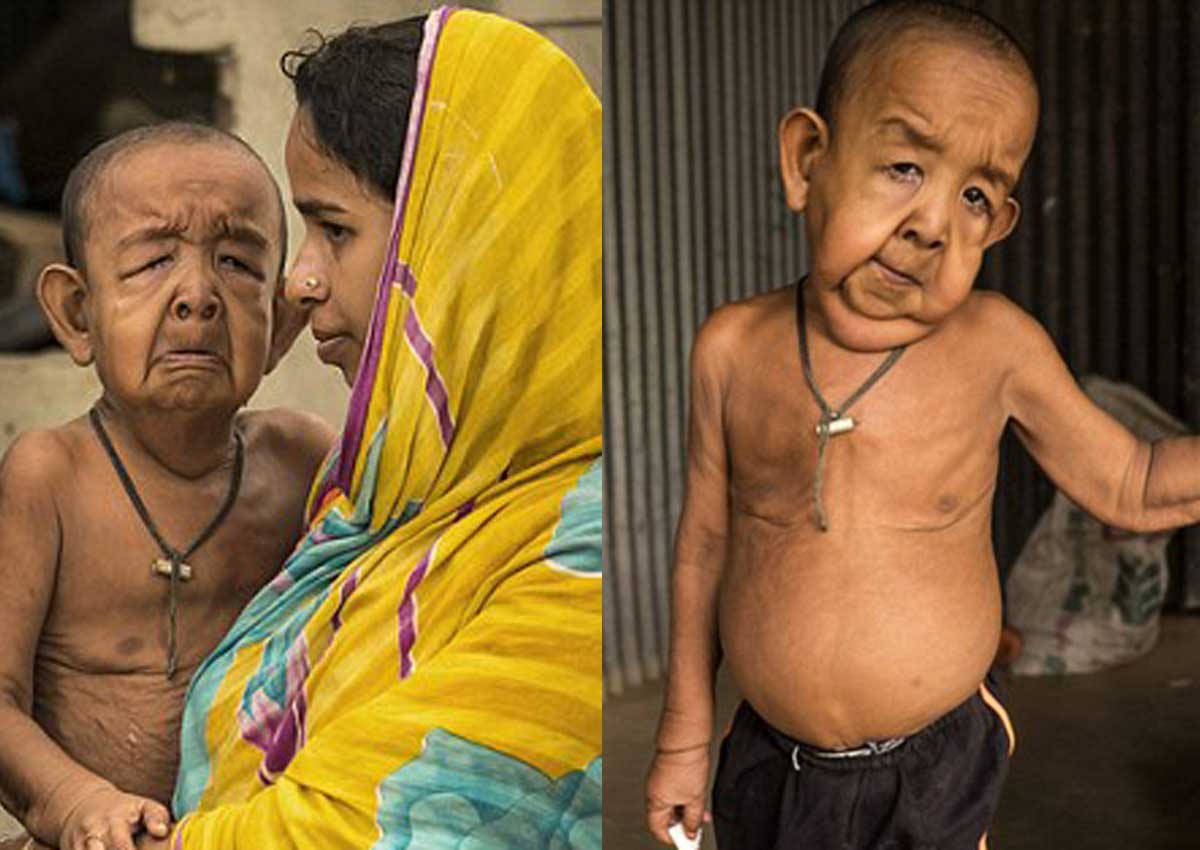 Meet the 'Benjamin Button' of Bangladesh who looks 80, but is just 4 ...