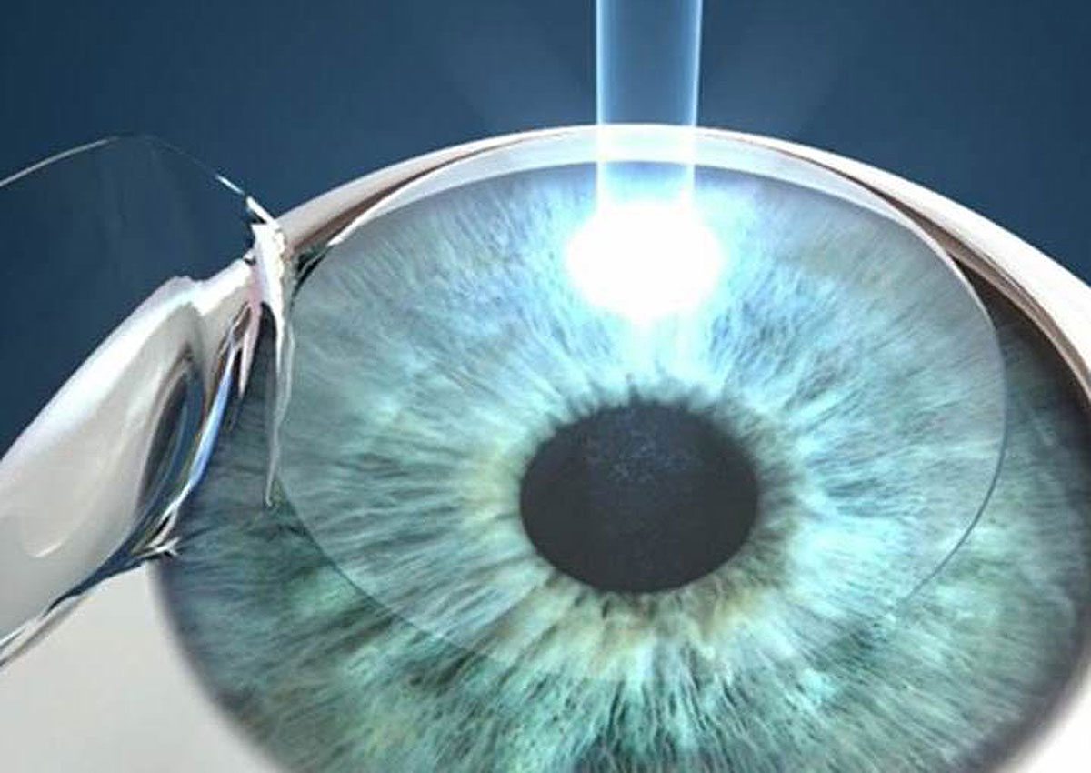 Lasik after cataract surgery is possible, News AsiaOne