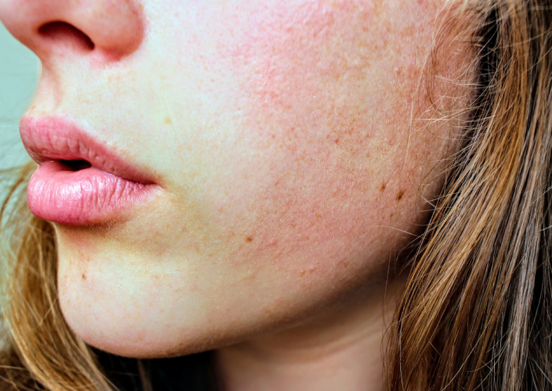 Featured image of post Flare-Up Skin - If your condition is keeping you.