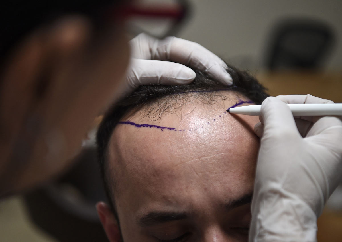 Hair Therapy Boosts Istanbul s Receding Tourism World Health News 