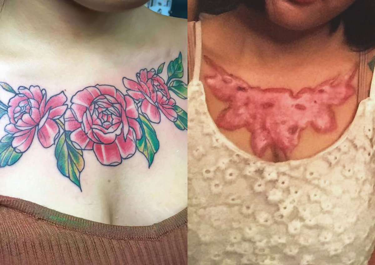 3. Non-Laser Tattoo Removal for Neck Tattoos - wide 8