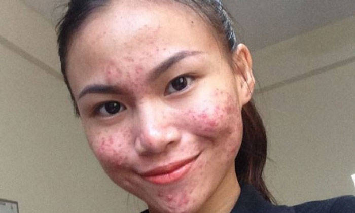 Pimply And Pretty 18 Year Old Malaysian Girl Unafraid To Flaunt Her Flawed Skin Malaysia News Asiaone