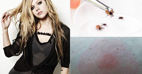 Avril Lavigne Feared Dying From Lyme Disease Health Health Health News Asiaone