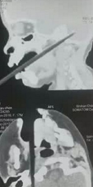 Toddler in China miraculously survives after chopstick pierces into her brain
