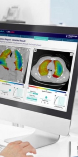 4DMedical lung imagery sheds more light on &#039;long Covid-19&#039; effects