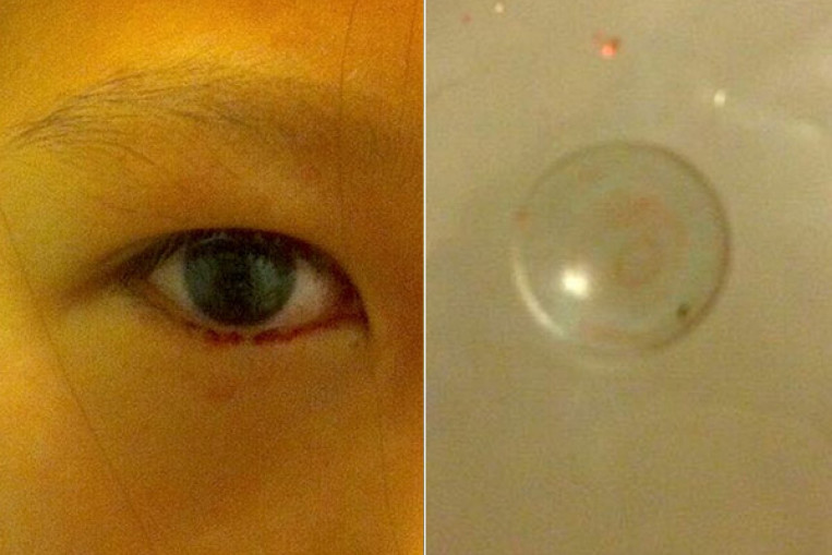 Girl, 11, cries bloodstained tears from contact lens stuck in eyelid