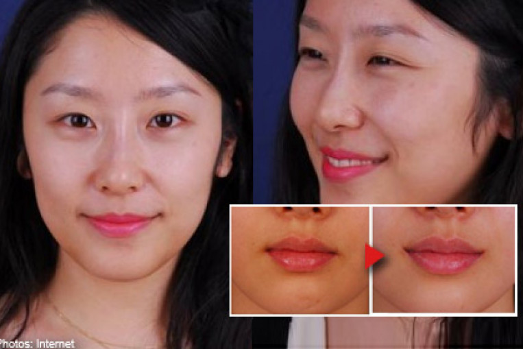 Операция по уменьшению малых. Азиатская операция на губы. Азиатские губы пластика.