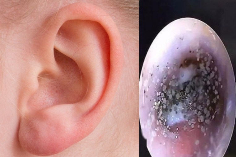 Mould' Found Growing In Boy's Ear Canal, Said To Be Due To Wearing Earphones Too Often, Lifestyle News - Asiaone