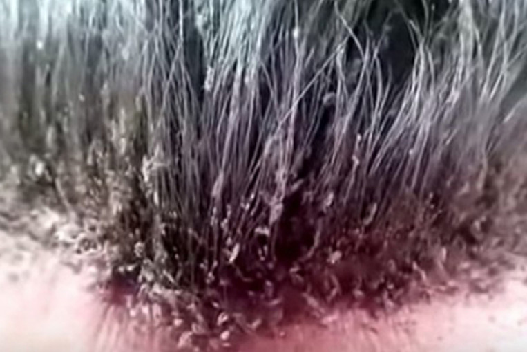 Video Clip Of Mans Head Lice Infestation Makes Viewers Skin Crawl