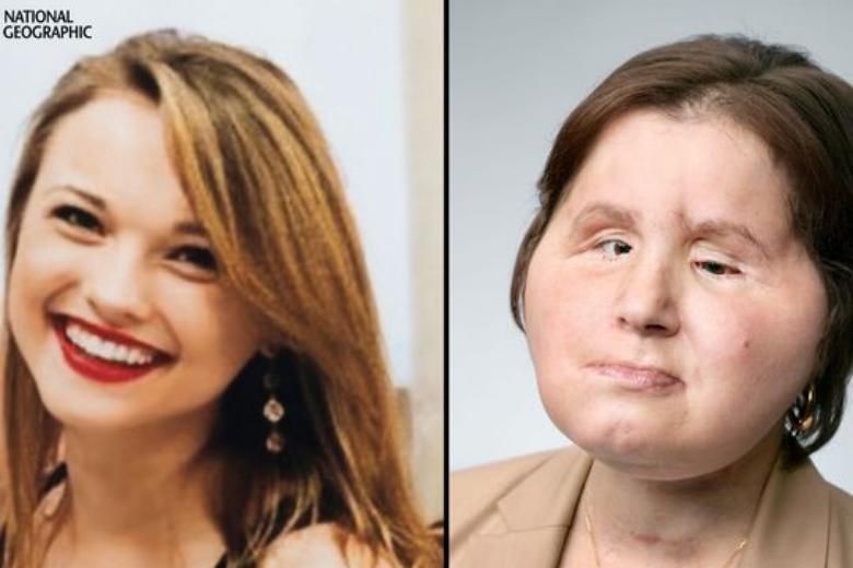 US woman who shot herself with hunting rifle is youngest person to get face transplant