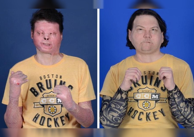 Lucky to be alive, owner of new face, hands learns to feel life anew