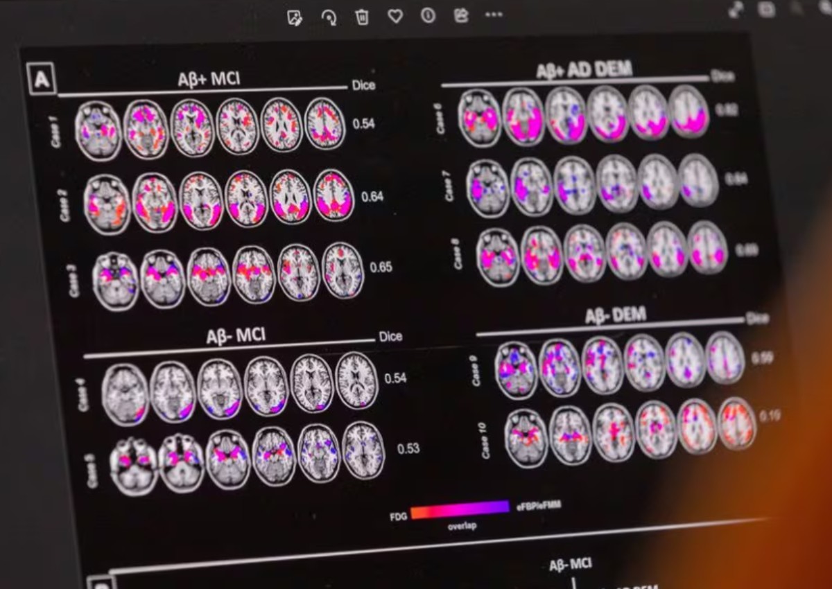 Proteins may predict who will get dementia 10 years later, study finds