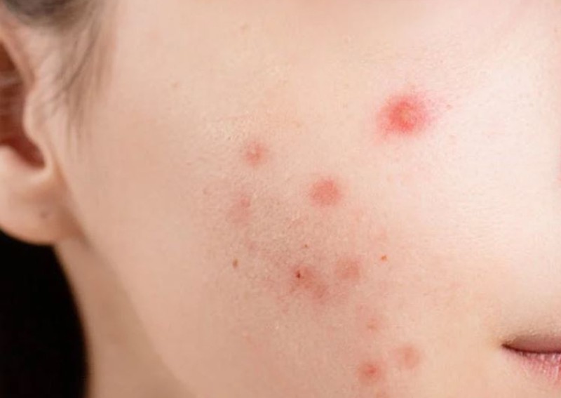 Acne treatment & acne scar removal in Singapore - how much does it cost?