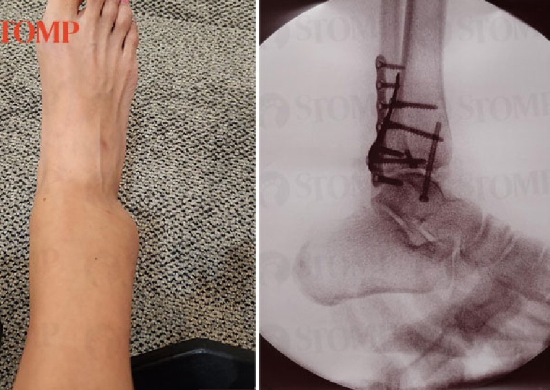 Woman suffers broken ankle after going down slide at indoor inflatable playground in Jurong East