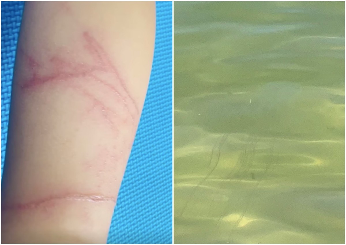 Mum warns others to be careful around Sentosa waters after jellyfish stings her 4-year-old daughter