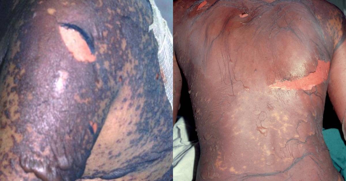 Daily roundup: 9 develop severe skin reactions from taking unregistered medicines — and other top stories today