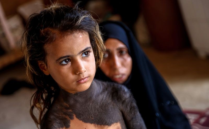 In an Iraqi village, a little girl hides skin disease from neighbours