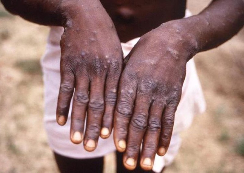 Quarantine ends for 18 people who came into close contact with monkeypox patient: MOH