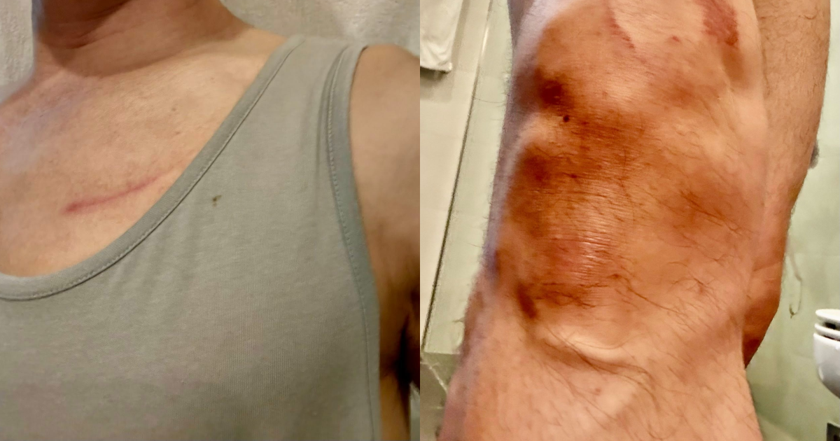 Baey Yam Keng, in charge of active mobility at Transport Ministry, suffers 'light abrasions' after being knocked down by bicycle