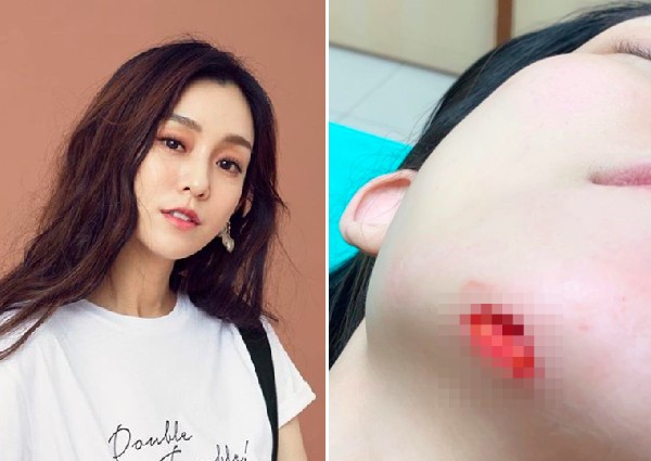 Singer Christine Fan injures face in fall, gets 15 stitches