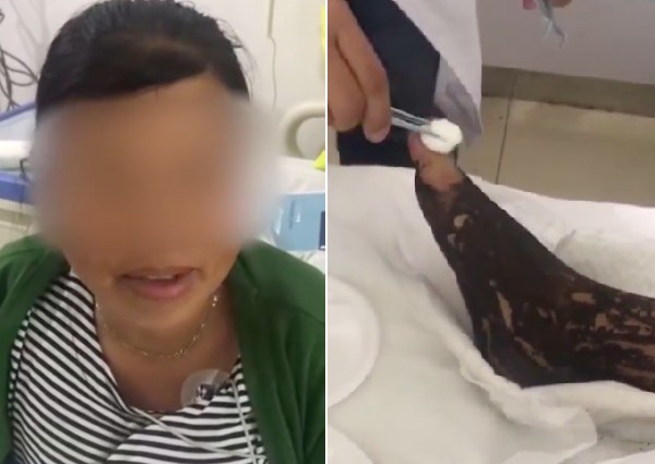 Woman in China tries to suck venom from snake bite, says she saw it on TV