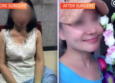 60-year-old woman in China undergoes plastic surgery, 'transforms' into lady in 20s to evade debtors