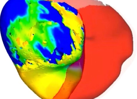 To fix a patient's irregular heartbeat, doctors first tested its digital 'twin' 