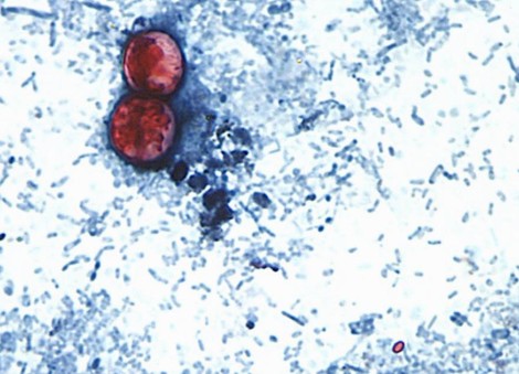 15 US states now linked to iceberg lettuce cyclospora outbreak, CDC says