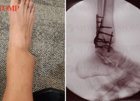 Woman suffers broken ankle after going down slide at indoor inflatable playground in Jurong East