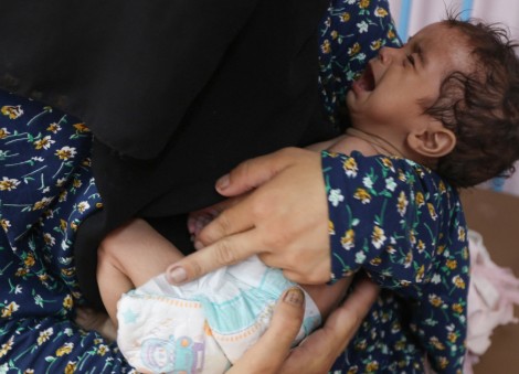 In Gaza malnutrition ward, a child's arm is as wide as mother's thumb