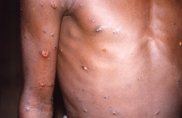 WHO calls emergency meeting as monkeypox cases cross 100 in Europe